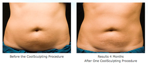 coolsculpting before and after