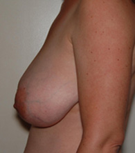 Breast Reduction