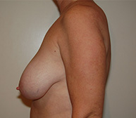 Breast Reduction