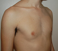 Gynecomastia
