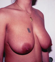 Breast Reduction
