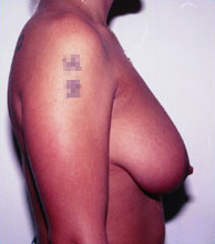 Breast Reduction