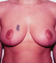 Breast Reduction