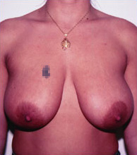Breast Reduction
