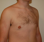 Gynecomastia