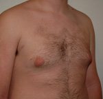 Gynecomastia