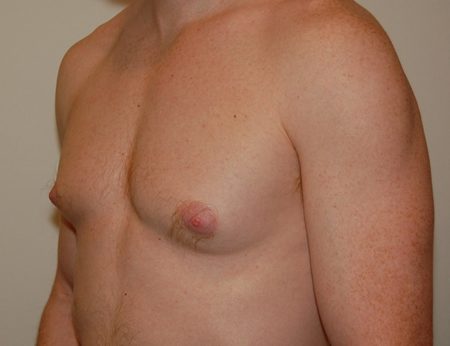 Gynecomastia