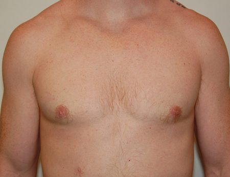 Gynecomastia