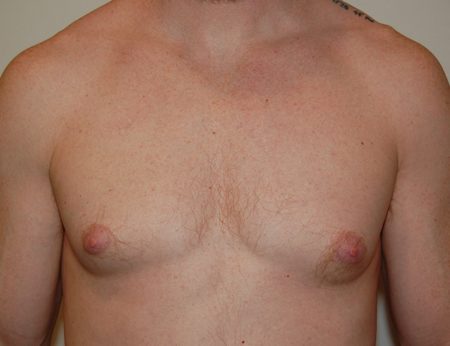 Gynecomastia