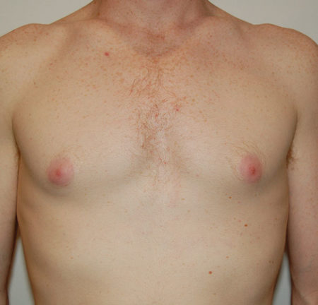 Gynecomastia