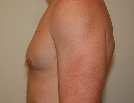 Gynecomastia