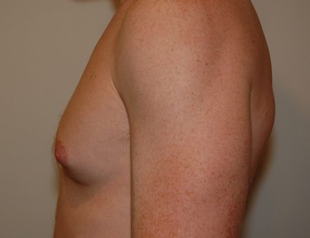 Gynecomastia