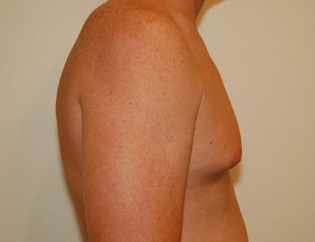 Gynecomastia