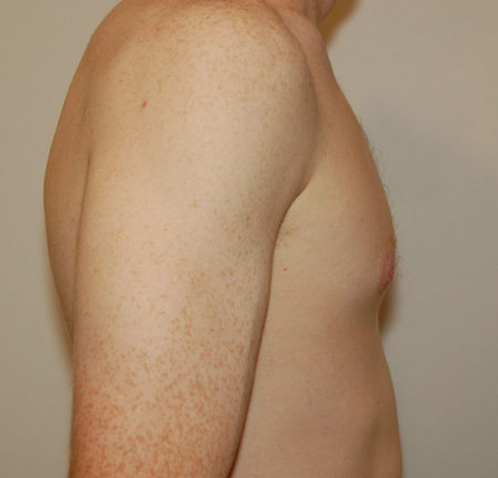 Gynecomastia