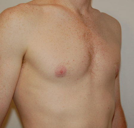 Gynecomastia