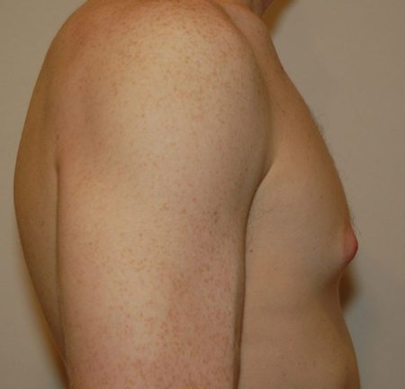 Gynecomastia